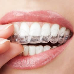 Invisalign treatment san antonio orthodontics