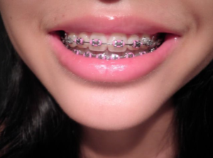 orthodontist san antonio